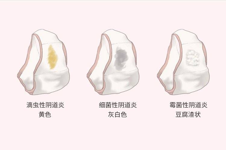 女性那个地方松弛是因为次数太多吗？大多是2个原因