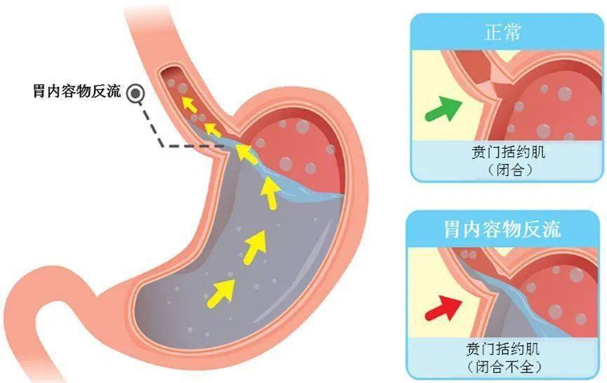 干咳和湿咳的区别是什么如何引起的(小孩经常咳嗽怎么办)