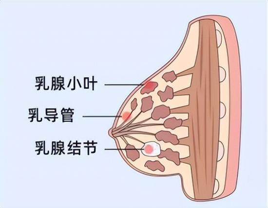 乳腺结节怎么回事会癌变吗(预防乳腺结节的方法)