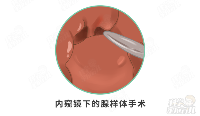 孩子腺样体肥大，应不应该手术切除？