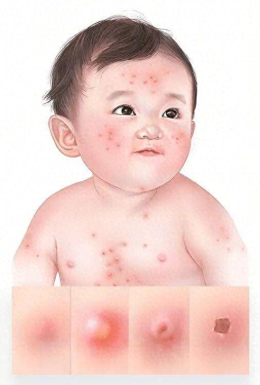 孩子出水痘什么症状(水痘的预防和治疗怎么做)