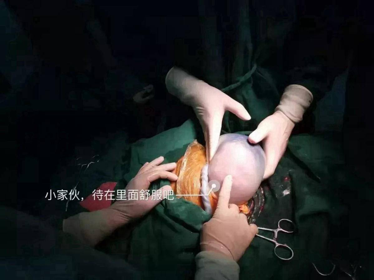 女子怀胎十月生下肉球 出生时胎膜没破的宝宝好不好
