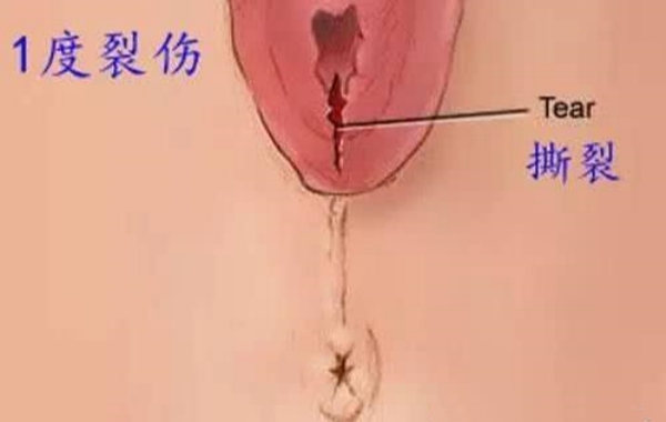 侧切和撕裂的图片对比(侧切和撕裂的区别)