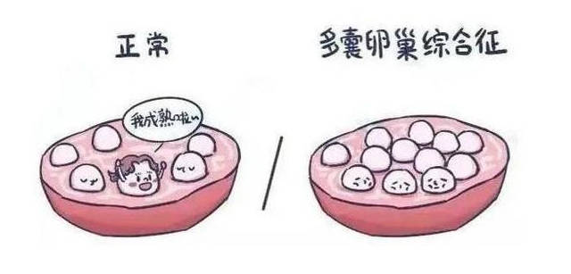 多囊卵巢综合症有哪些症状(多囊卵巢备孕注意事项)