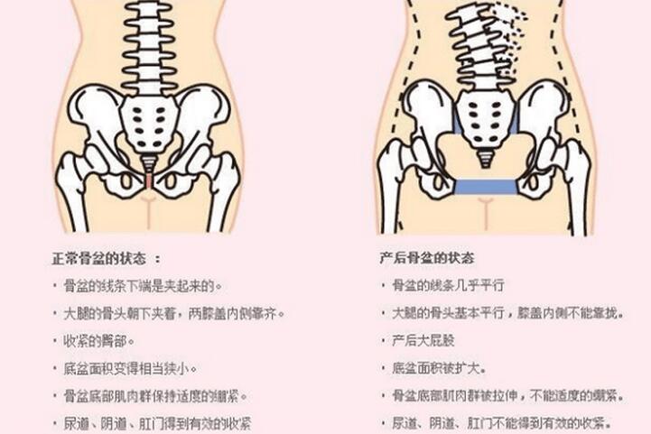 骨盆修复真的有效果吗有必要吗(做骨盆修复有什么好处)
