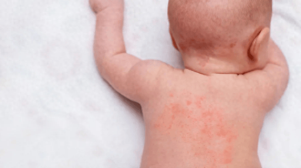 小孩湿疹反复不断是什么原因(婴儿湿疹的护理方法和治疗)