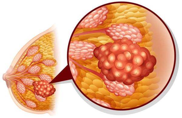 乳腺增生和乳腺癌的区别在哪里(附3法鉴别)