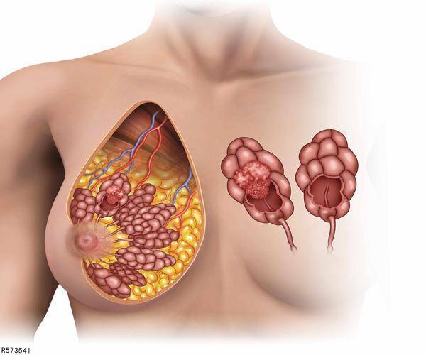 乳腺增生和乳腺癌的区别在哪里(附3法鉴别)