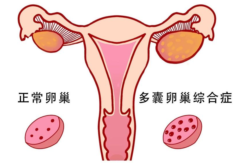 多囊卵巢综合征拖久了会怎样(多囊卵巢怎么调理)