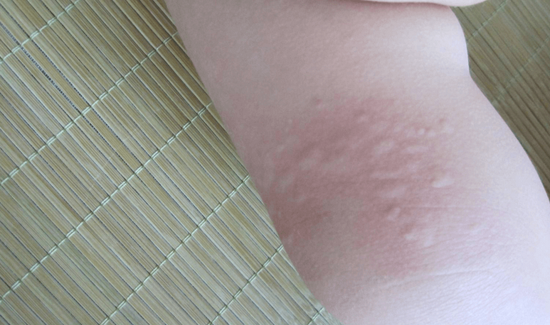 哺乳期不忌口的危害有哪些(母乳妈妈不忌口对孩子的影响)