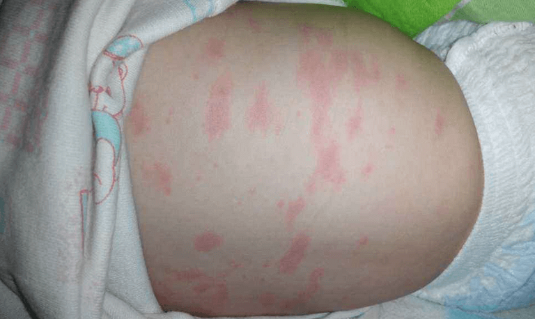 怎么判断是不是幼儿急疹(幼儿急疹与症状相似病如何区分)