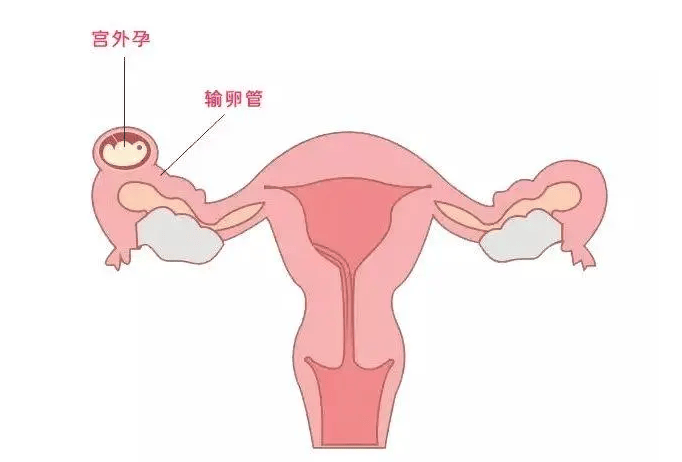 为什么会有宫外孕(如何预防宫外孕的发生)