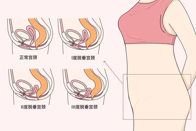 子宫脱垂有哪些病因症状(怎样治疗子宫脱垂)