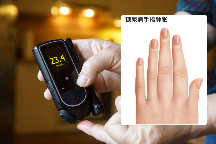 睡觉时会有什么异常表现提示血糖升高呢(糖尿病患者手上会有什么症状及如何
