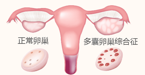 多囊卵巢的症状表现有哪些(疑似多囊卵巢怎么办)