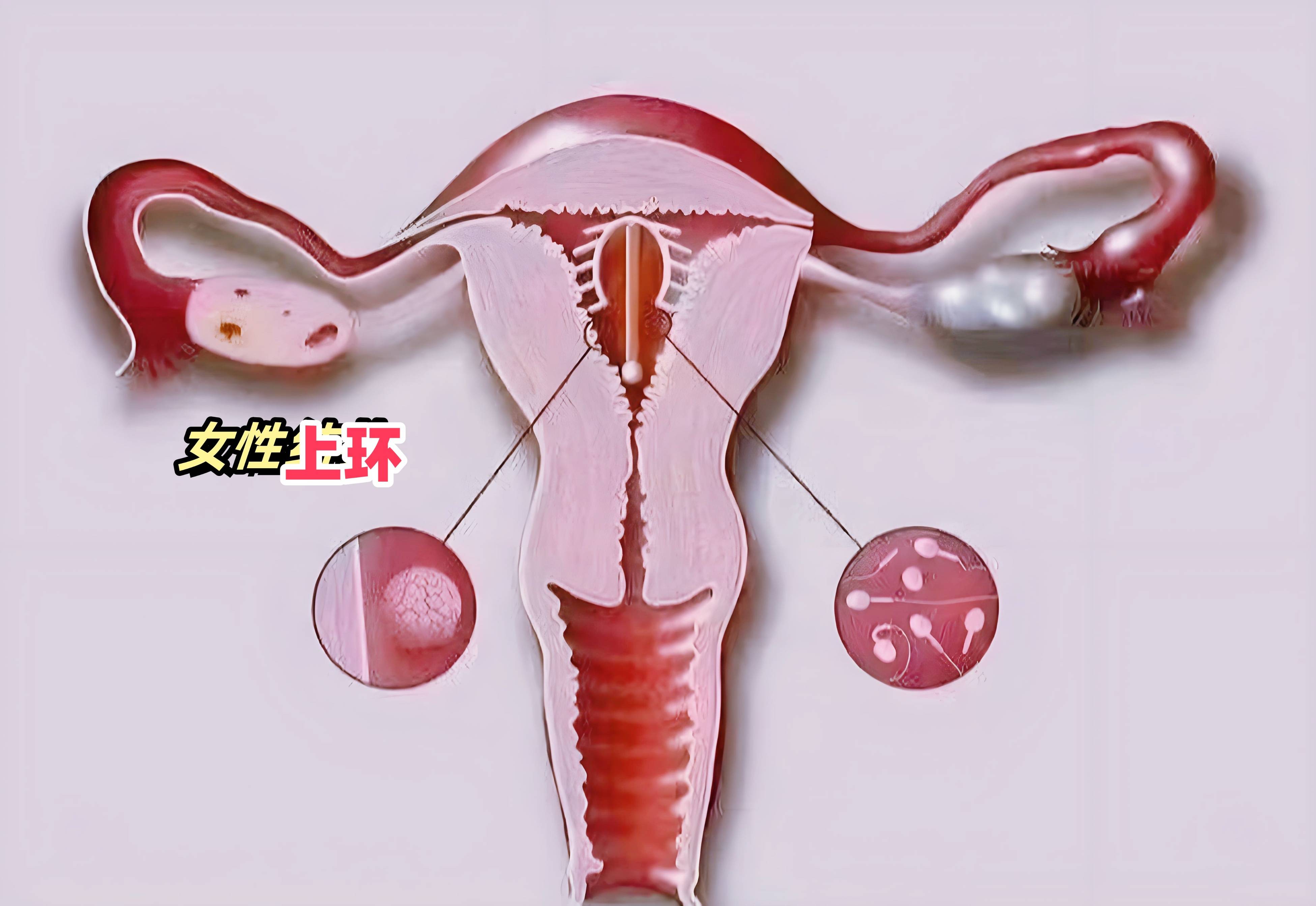 不想生孩子了是结扎好还是上环好？盘点女性最喜欢的避孕方式