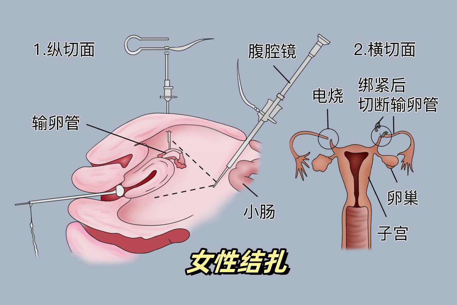 不想生孩子了是结扎好还是上环好？盘点女性最喜欢的避孕方式
