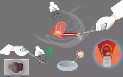 逐步讲解试管婴儿取卵前需要准备什么？这4个准备工作要做好