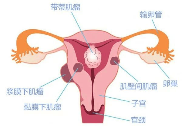 子宫肌瘤需不需要治疗(子宫肌瘤无明显症状的治疗方法)