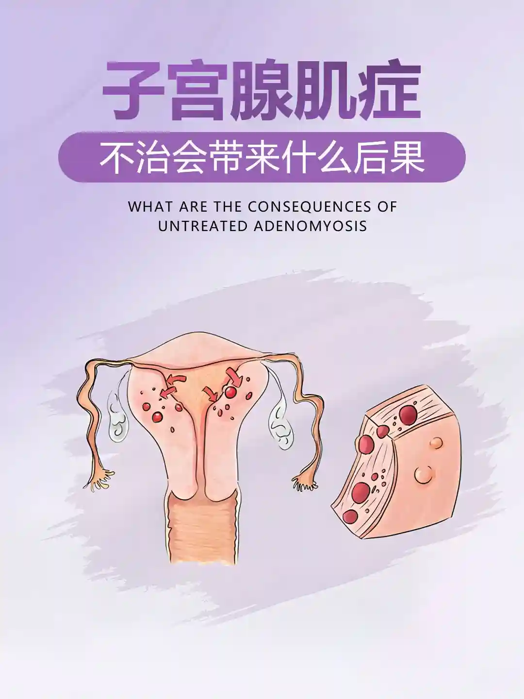 【干货分享】子宫腺肌症不治疗会带来什么样的后果！