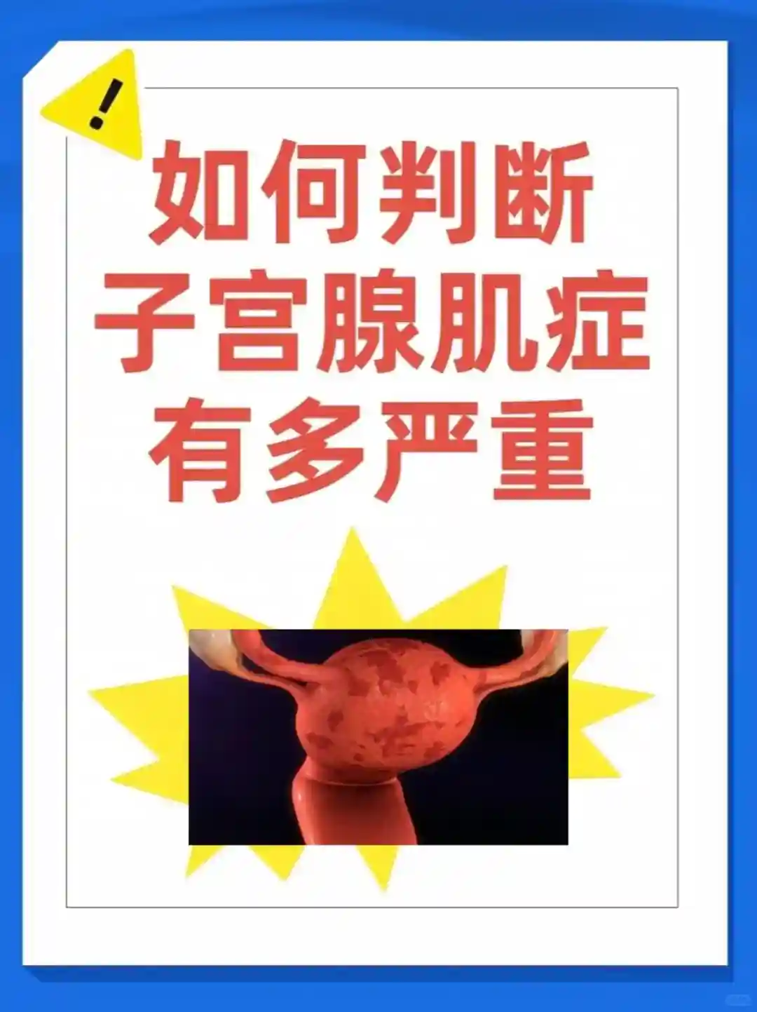 子宫腺肌症的科普：如何判断子宫腺肌症有多严重？