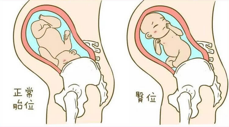 孕妇臀位是怎么引起的(胎儿臀位的几率是多少)