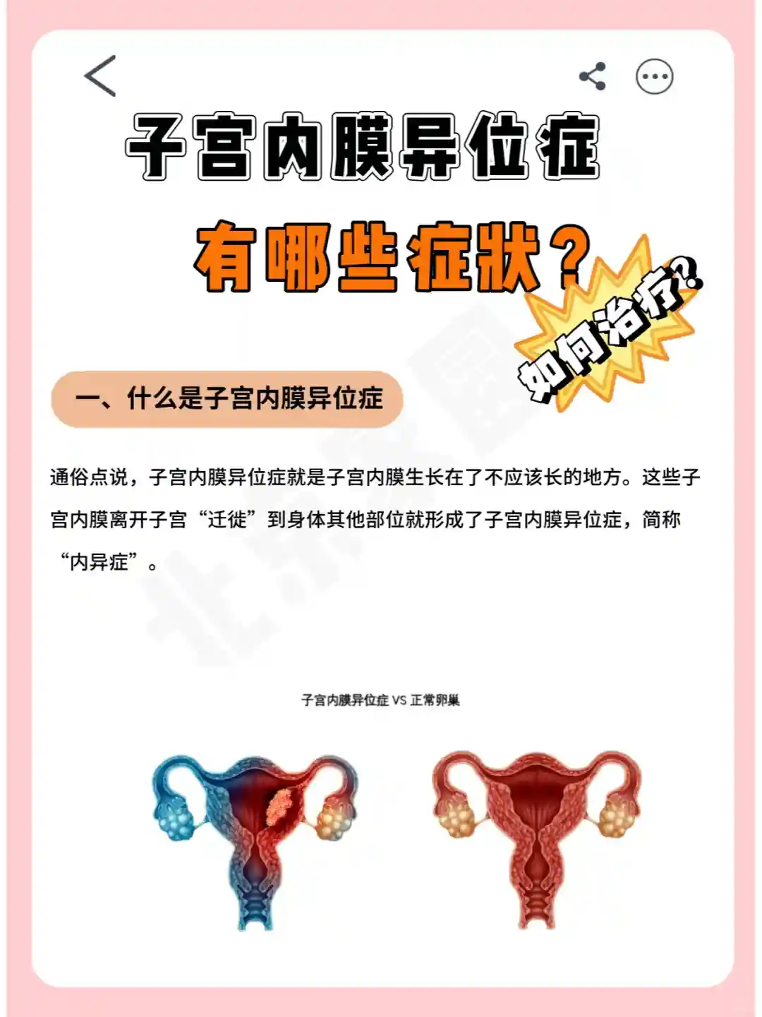 子宫内膜异位症有哪些症状？如何治疗？