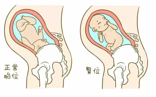 孕期胎儿臀位的危害有哪些(附关于臀位看看孕妈妈们怎么说)