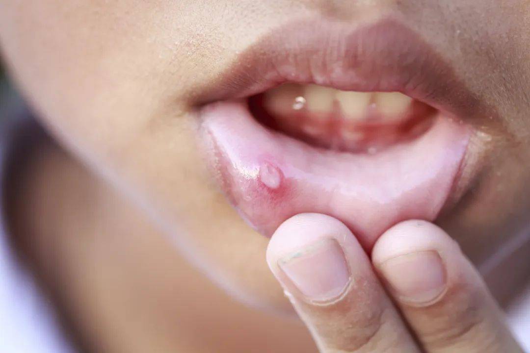 孕妇口腔溃疡要怎么办？盘点导致孕妇口腔溃疡的原因