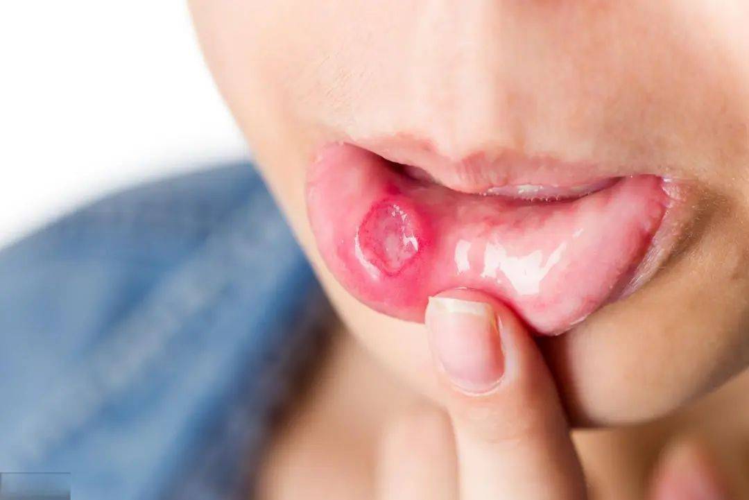 孕妇口腔溃疡要怎么办？盘点导致孕妇口腔溃疡的原因