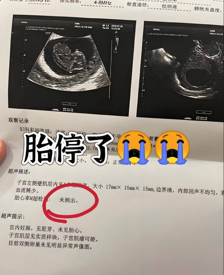 大龄剩女嫁二婚男：4次胎停后23周羊水早破,保胎失败无奈流产