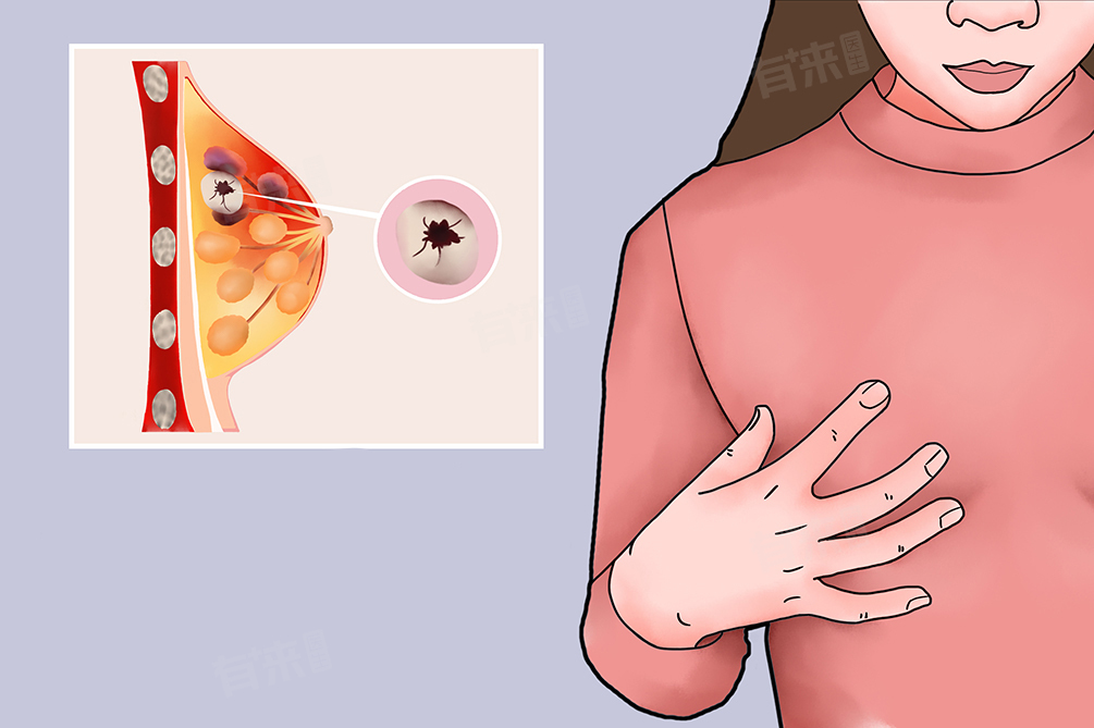 右侧乳房下边位置疼是什么原因 右侧乳房下边位置疼需要如何缓解