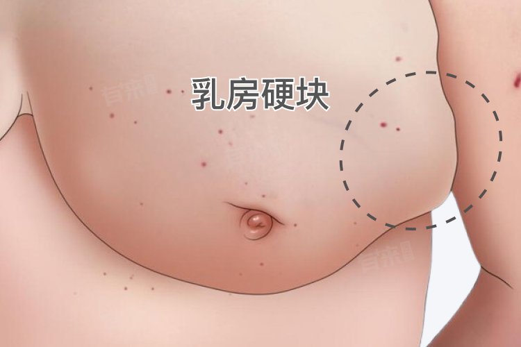 堵奶热敷还是冷敷 堵奶后的护理要点