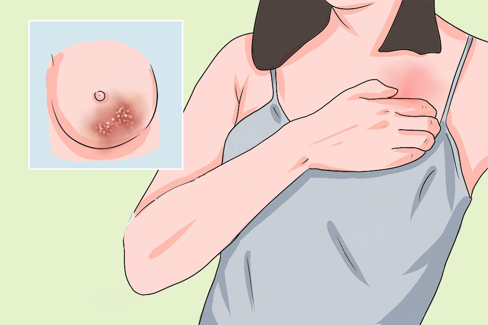 乳头周围有小颗粒是怎么回事 乳头周围出现小颗粒的注意事项