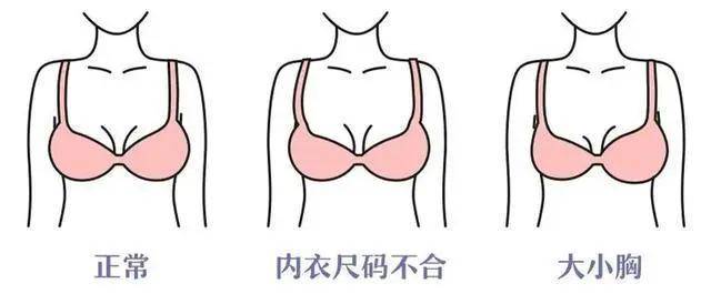 令人尴尬的大小胸,如何改善和预防？