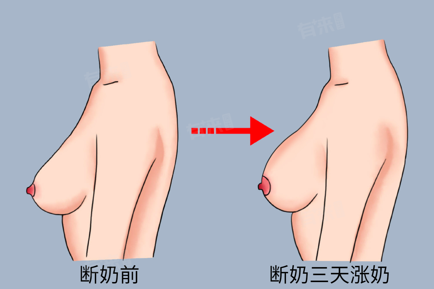 不喂奶涨奶几天可以自行消失