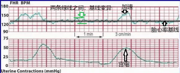 胎心监护图怎么看？监护不过关是胎儿缺氧了吗？