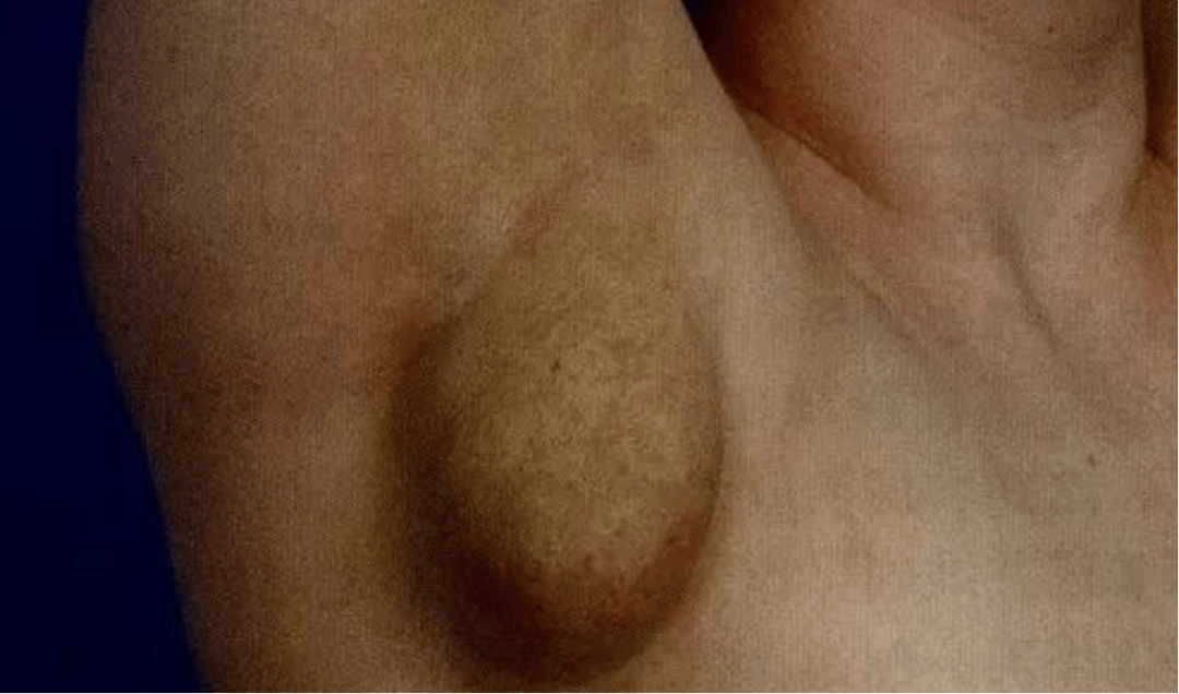 怀孕后长副乳怎么回事？关于副乳的真相