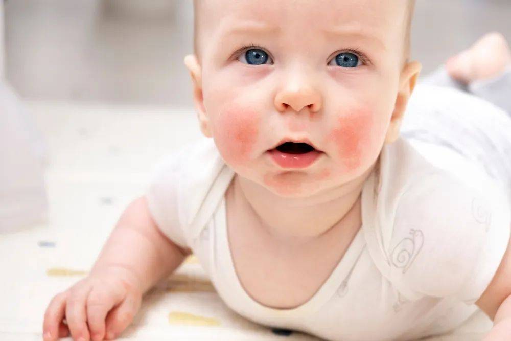 宝宝疹子有哪几种？这6种教你有效应对
