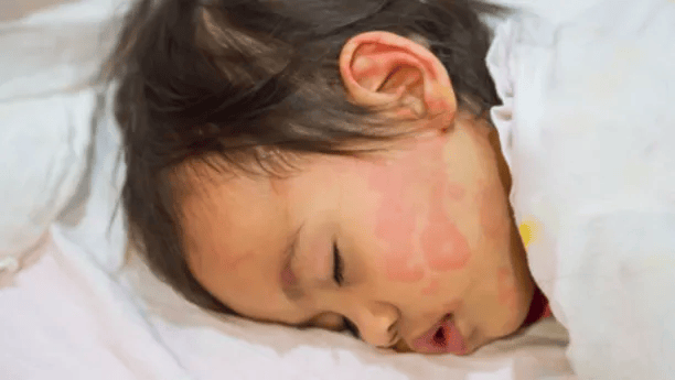 宝宝疹子有哪几种？这6种教你有效应对
