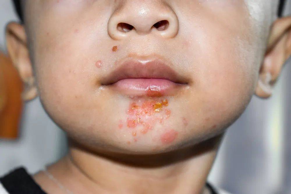 宝宝疹子有哪几种？这6种教你有效应对