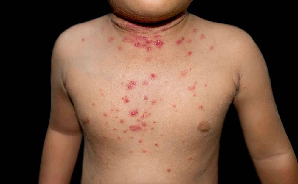 宝宝疹子有哪几种？这6种教你有效应对