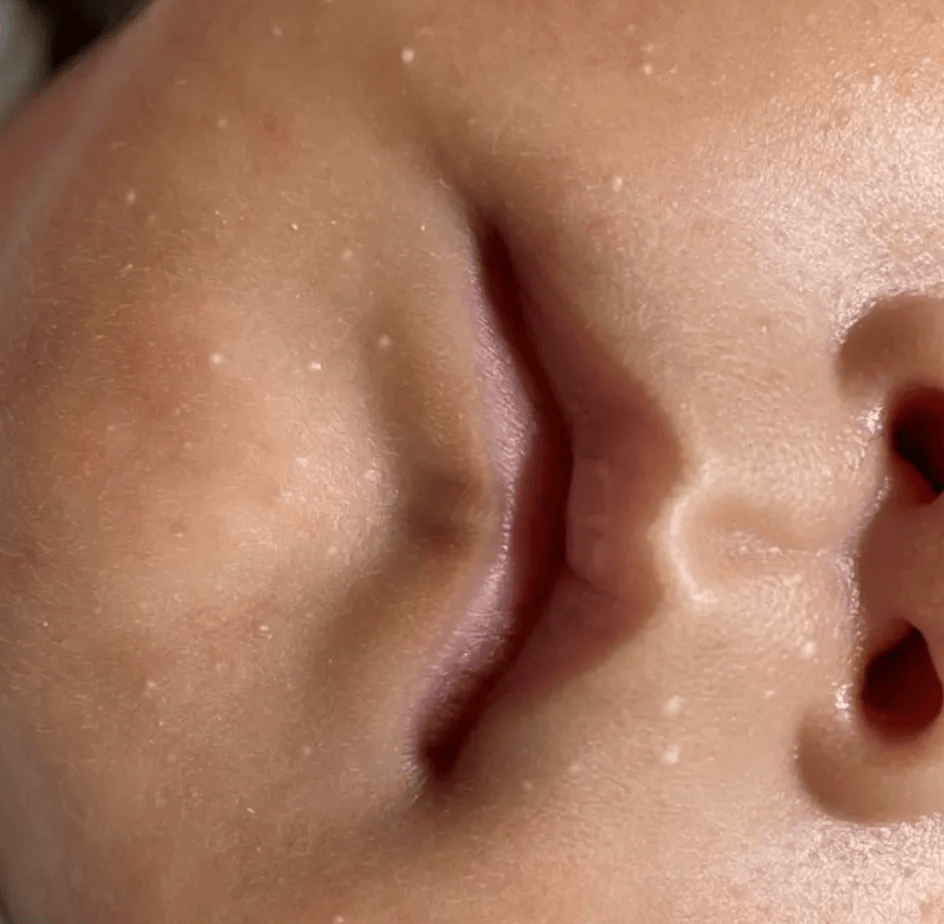 宝宝疹子有哪几种？这6种教你有效应对