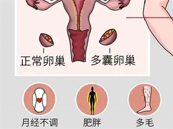区分多囊卵巢严重程度的办法(卵巢有多少个卵泡算多囊)